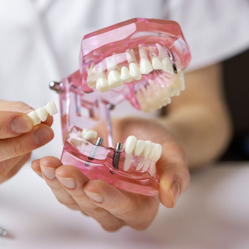 A person is holding a model of their teeth in their hands.