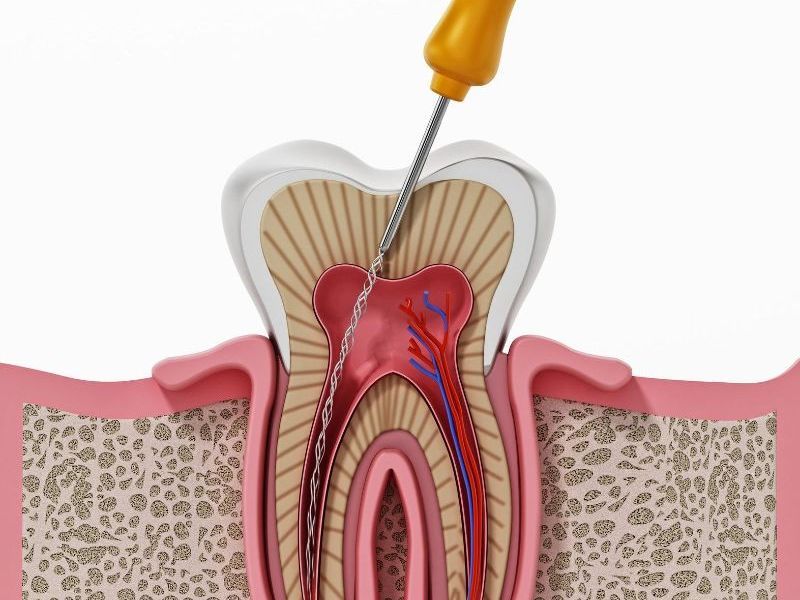 root canals
