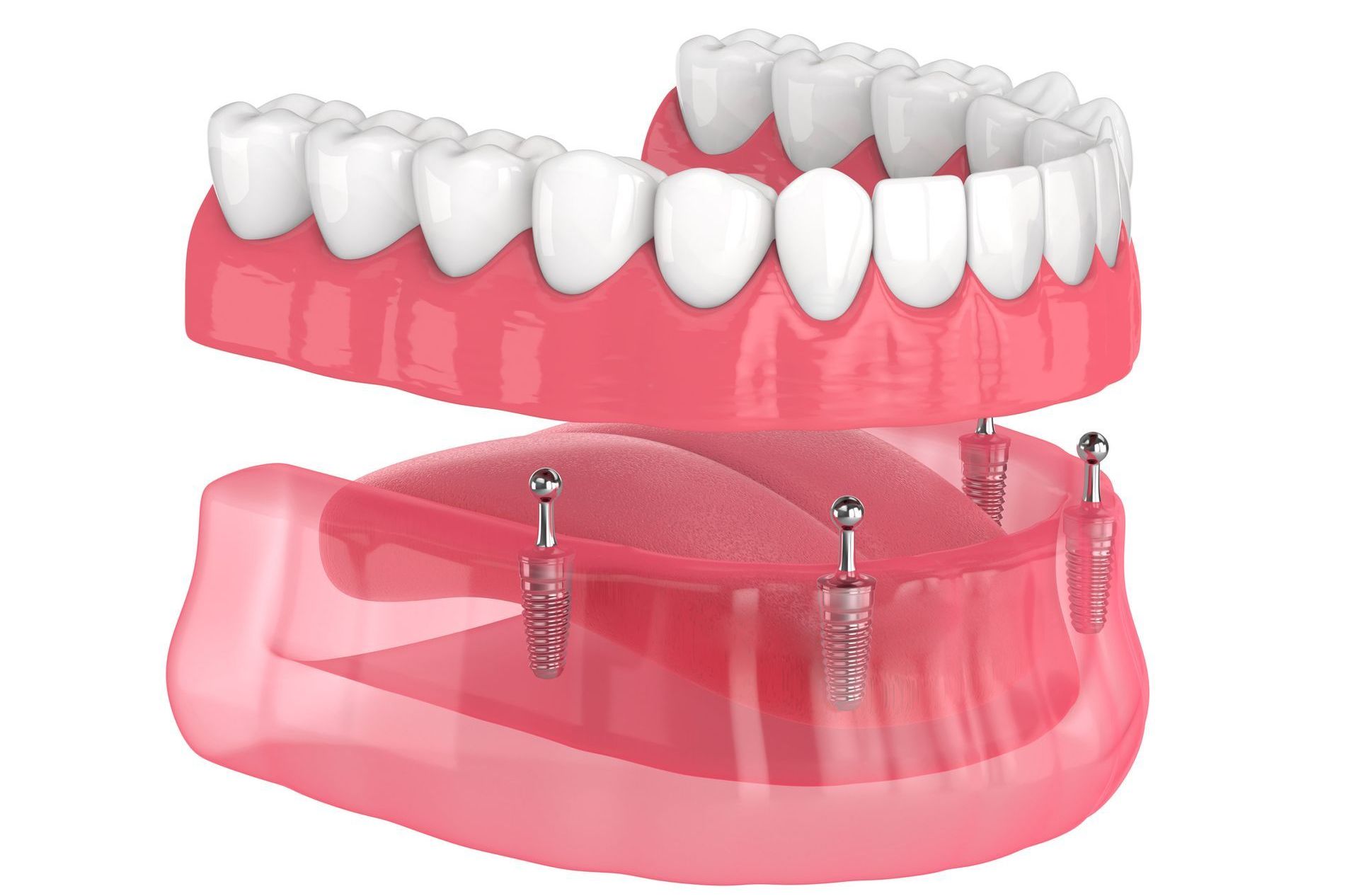 dental dentures