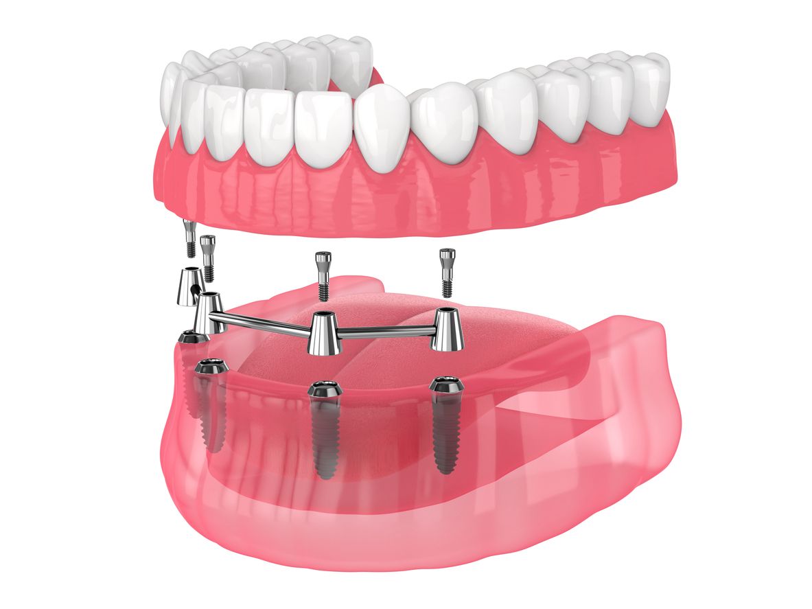 A 3d rendering of a full denture with dental implants.