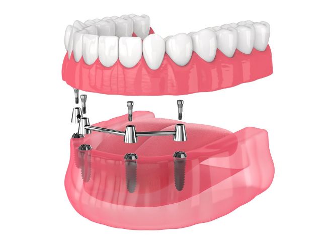 Una imagen generada por computadora de una dentadura completa con implantes dentales.