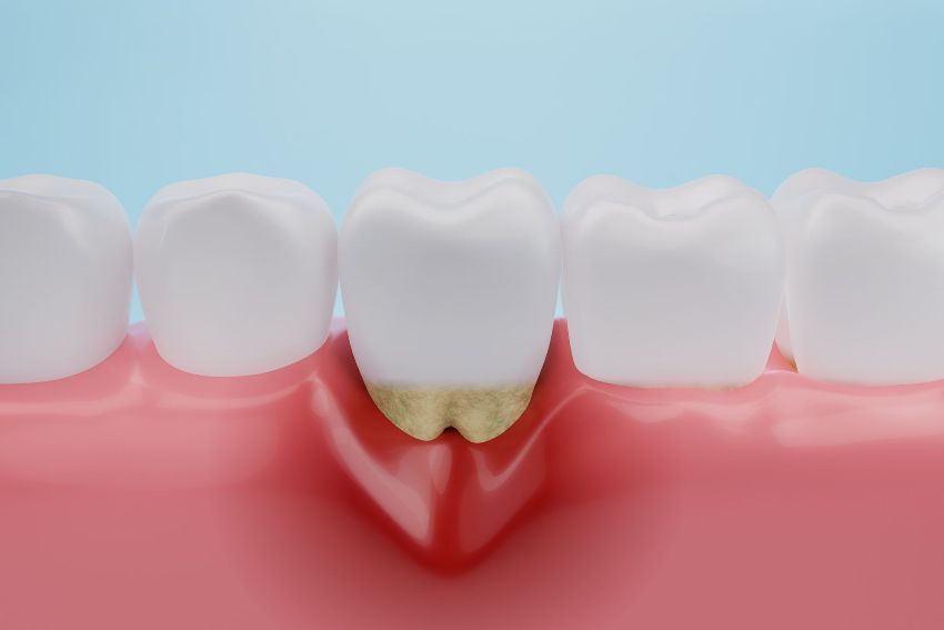 gum disease treatment