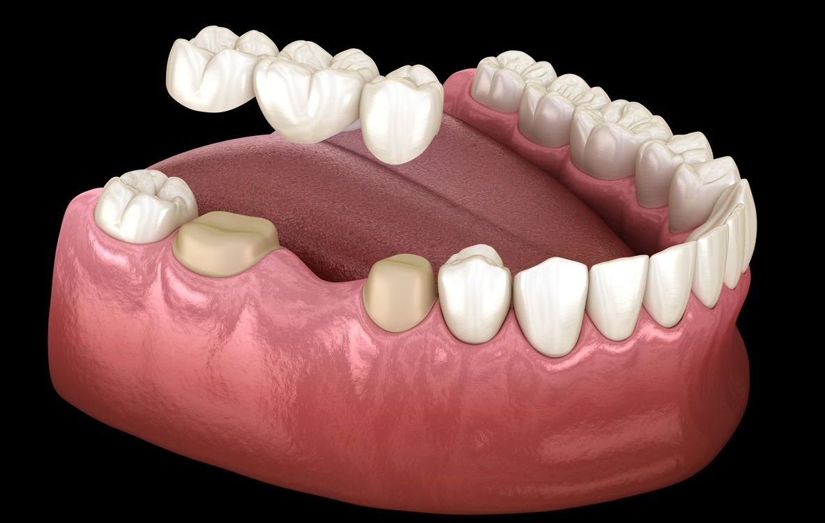 A model of a person's teeth with a dental bridge.