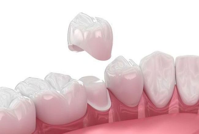 dental crowns