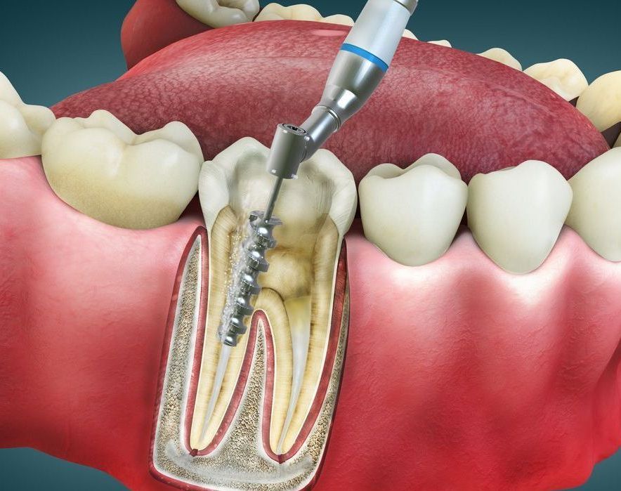 A dental drill is being used to remove a tooth