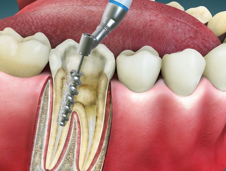 Se está utilizando un taladro dental para extraer un diente.