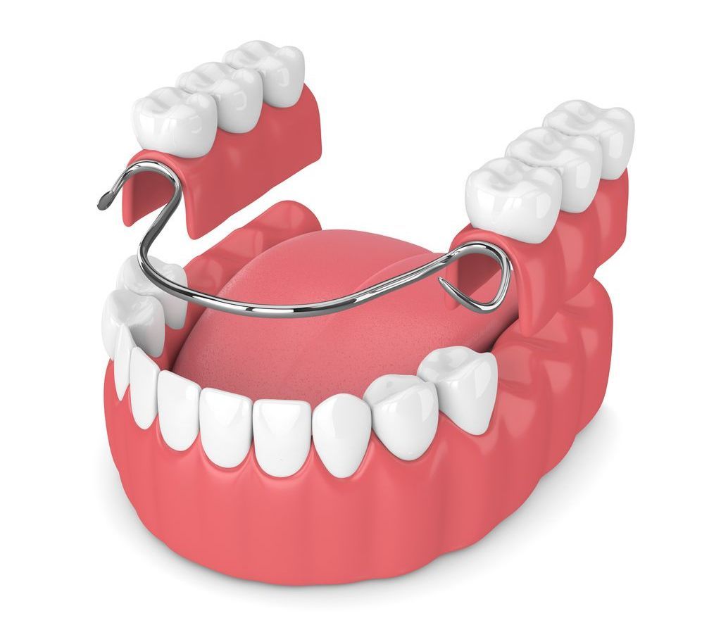 A computer generated image of a denture with a metal wire attached to it.