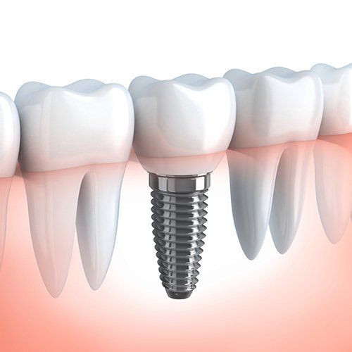 odontologia de implantes