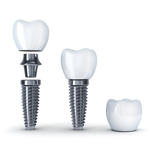 A 3d rendering of a dental implant and a tooth.