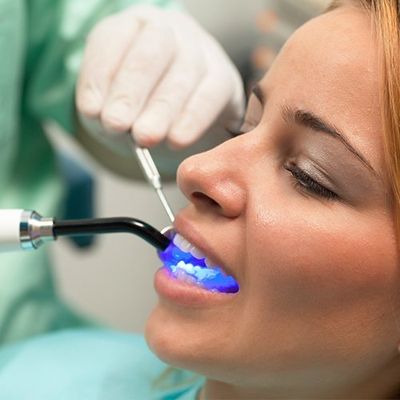 tooth colored fillings being applied to woman