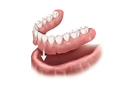 Immediate denture