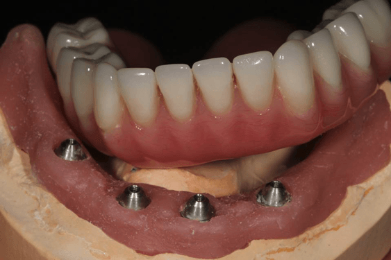 Implant overdentures