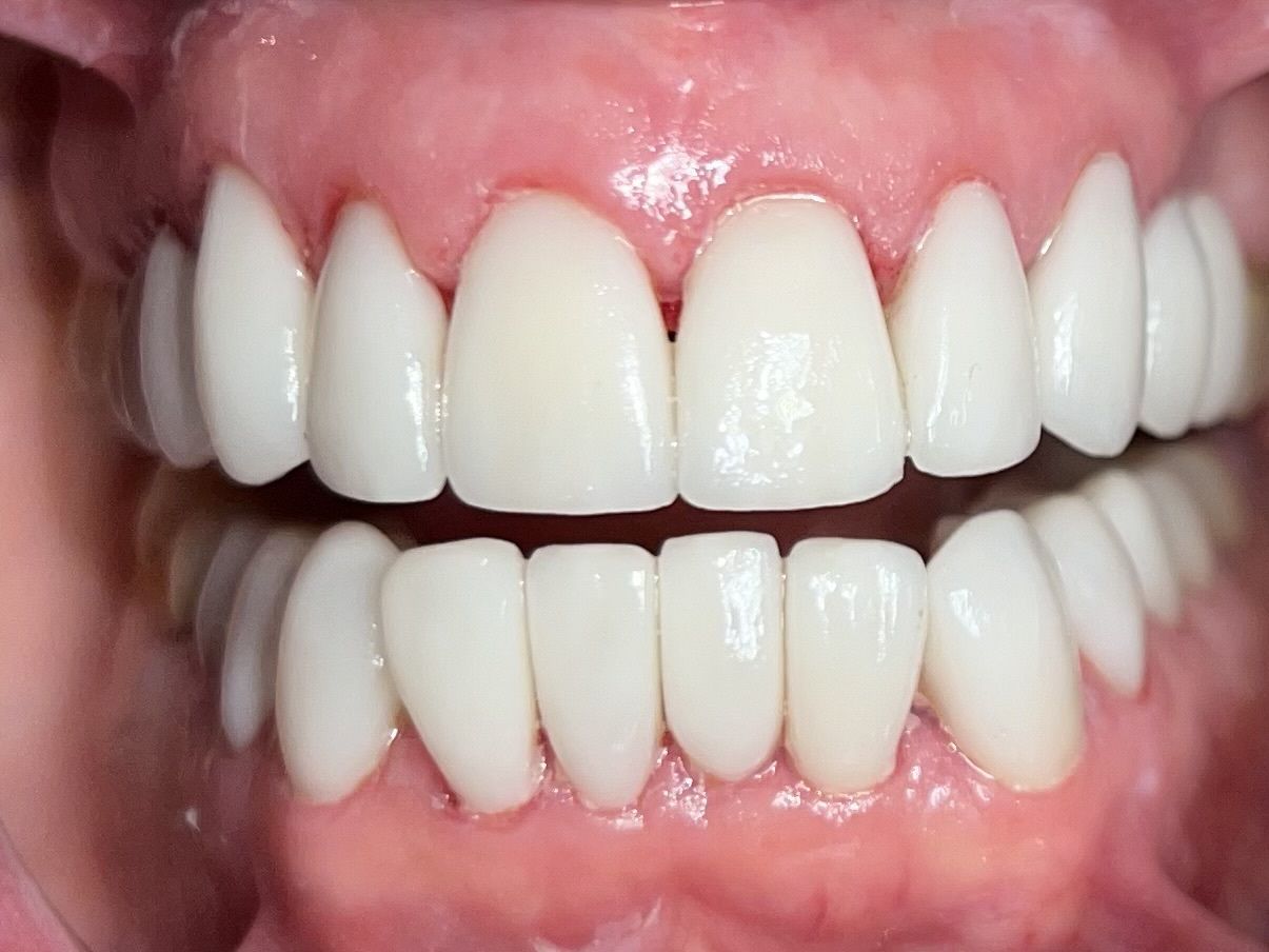 A close up of a person 's teeth with white teeth.