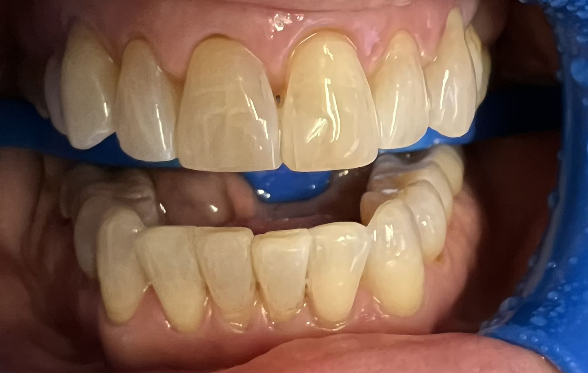 A close up of a person 's teeth with a blue rubber band around them.