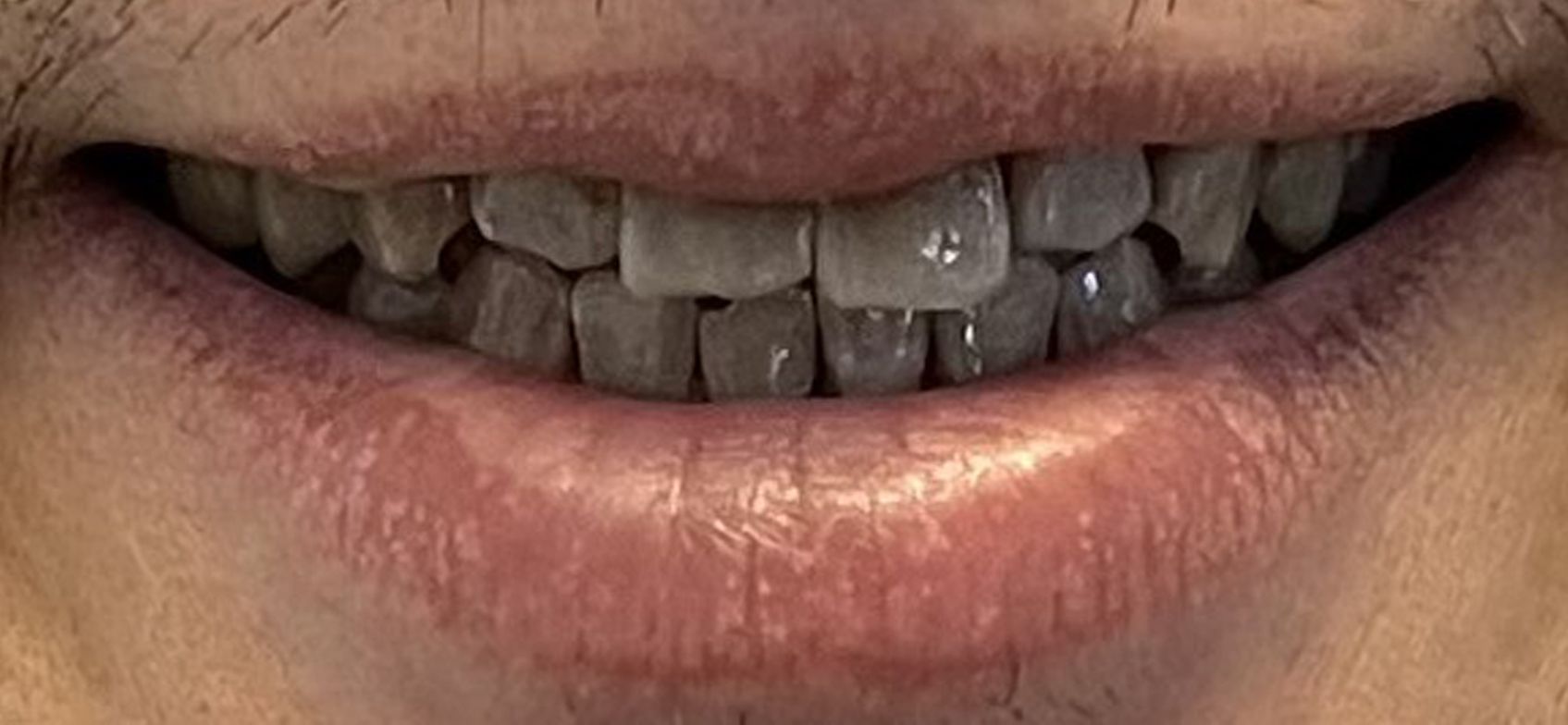 A close up of a man 's mouth with his teeth showing.