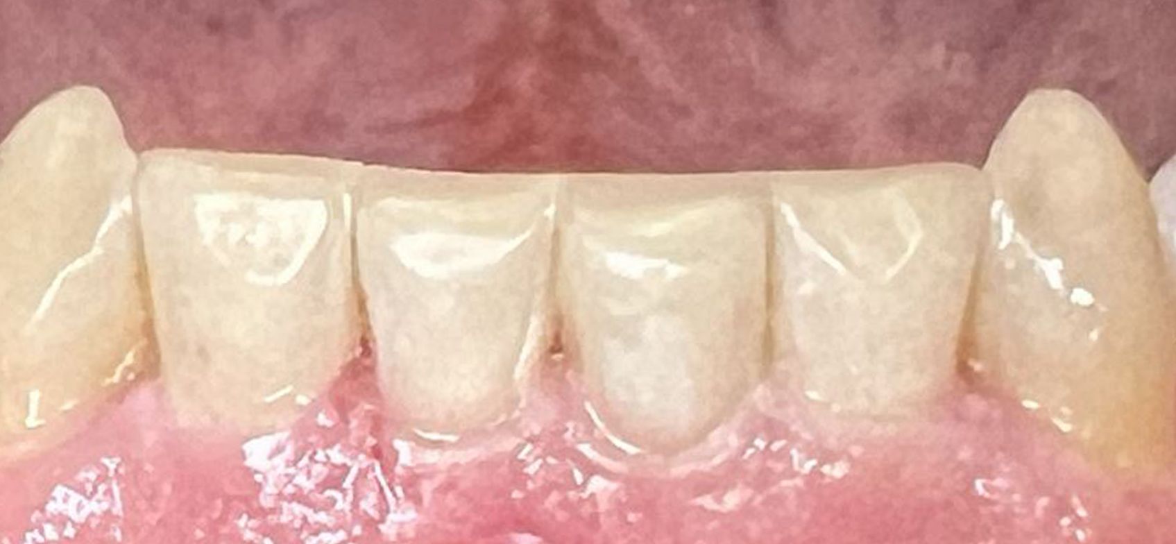 A close up of a person 's teeth with a pink background.