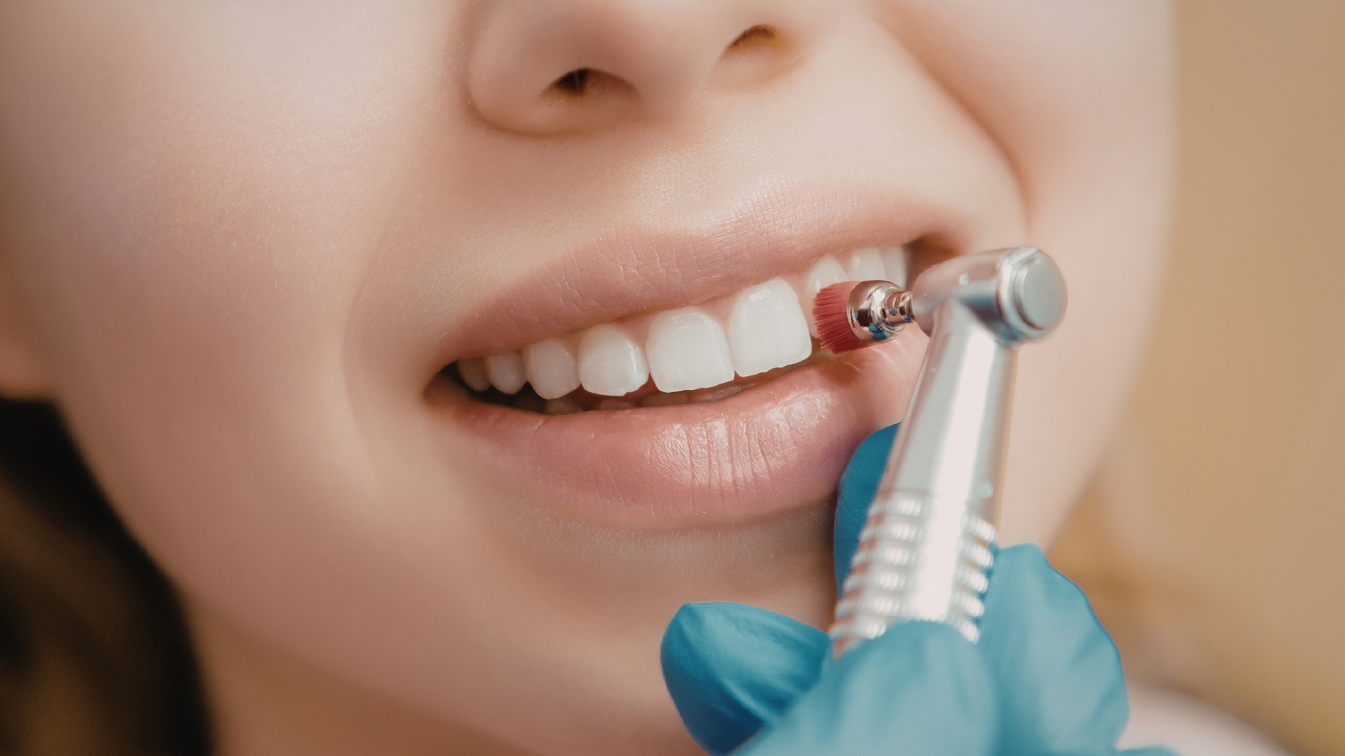 Close-up of a person’s mouth during a dental procedure, with a gloved hand using a small rotary dental tool to clean or polish the front teeth.