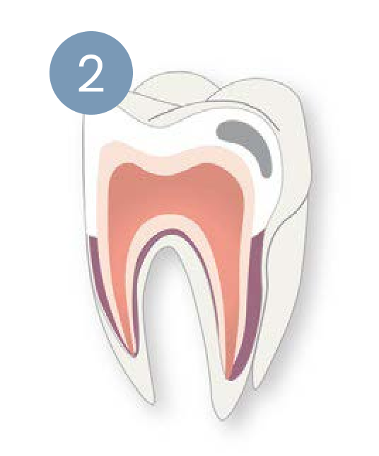 A diagram of a tooth with a number 2 next to it.