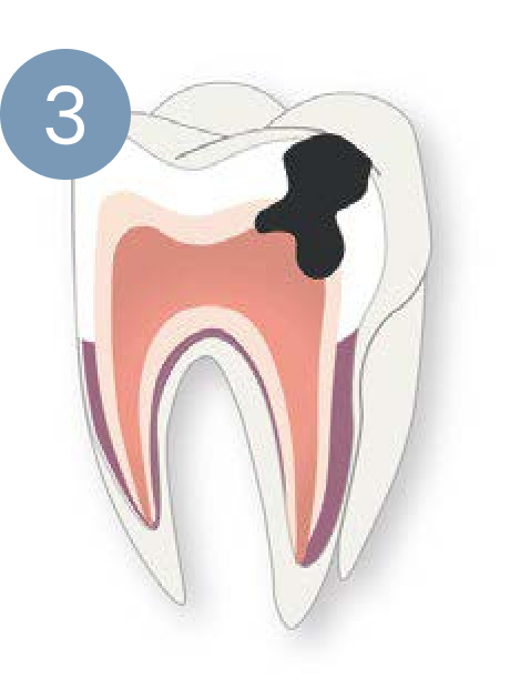 A diagram of a tooth with a black spot on it.