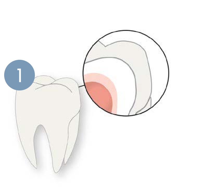 A tooth with a hole in it and a circle around it.