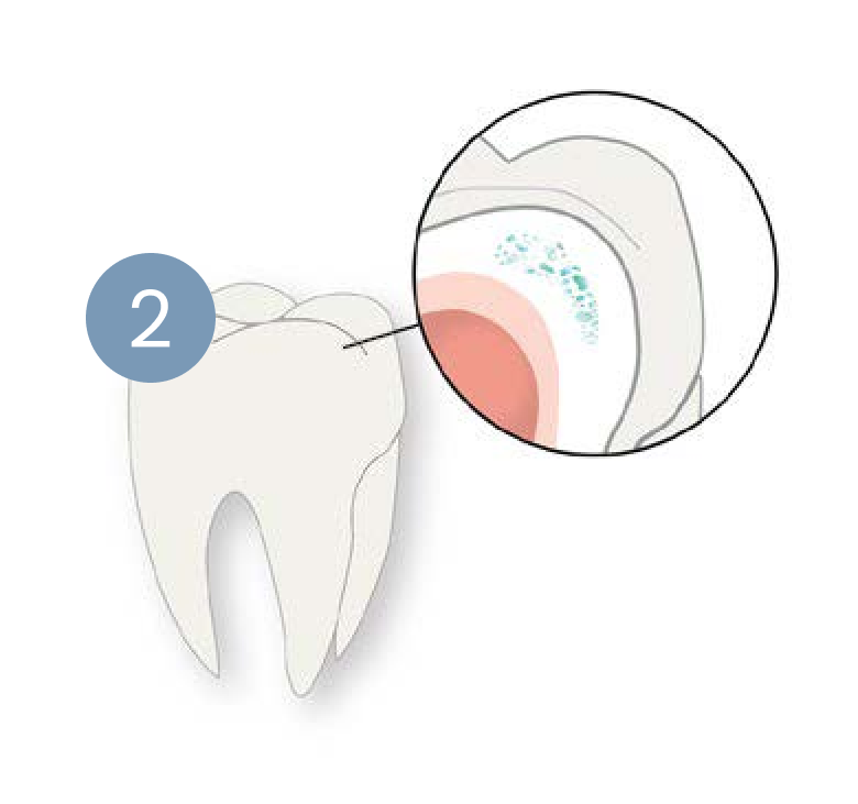 A tooth with a hole in it and a circle around it.