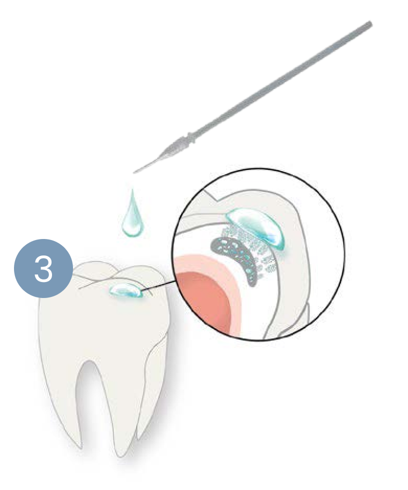 A tooth with a toothbrush and a drop of liquid on it.