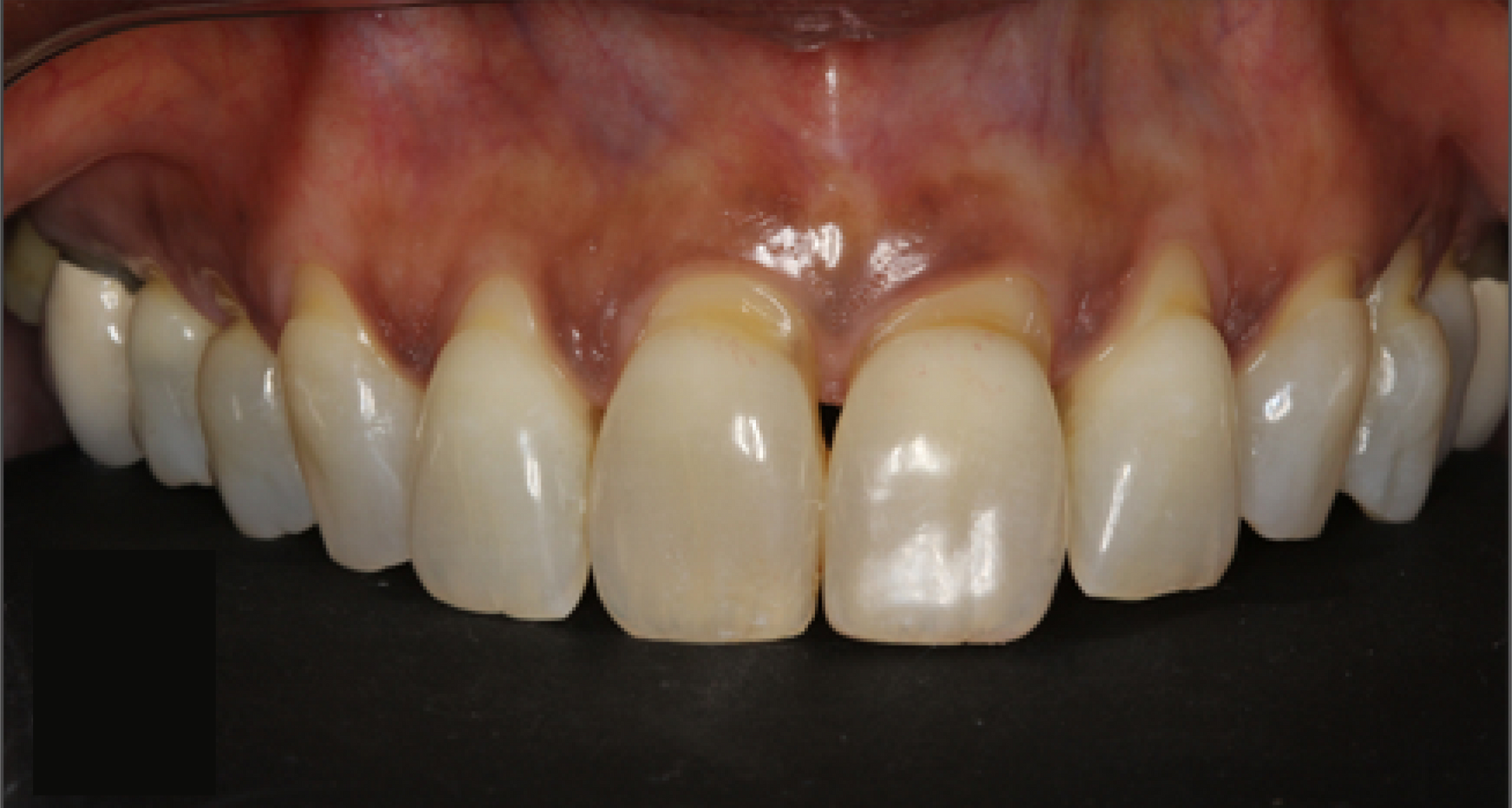 A close up of a person 's teeth with a black background.