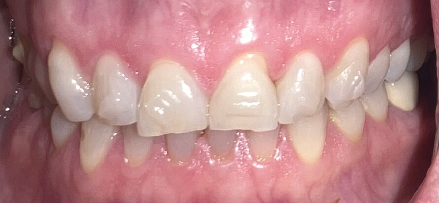 A close up of a person 's teeth and gums.