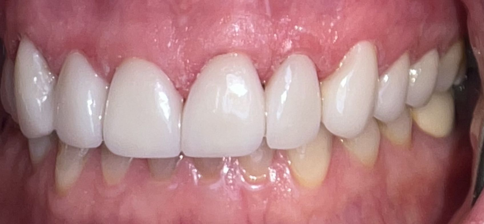 A close up of a person 's teeth with white teeth.