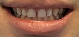 A close up of a person 's mouth with their teeth showing.