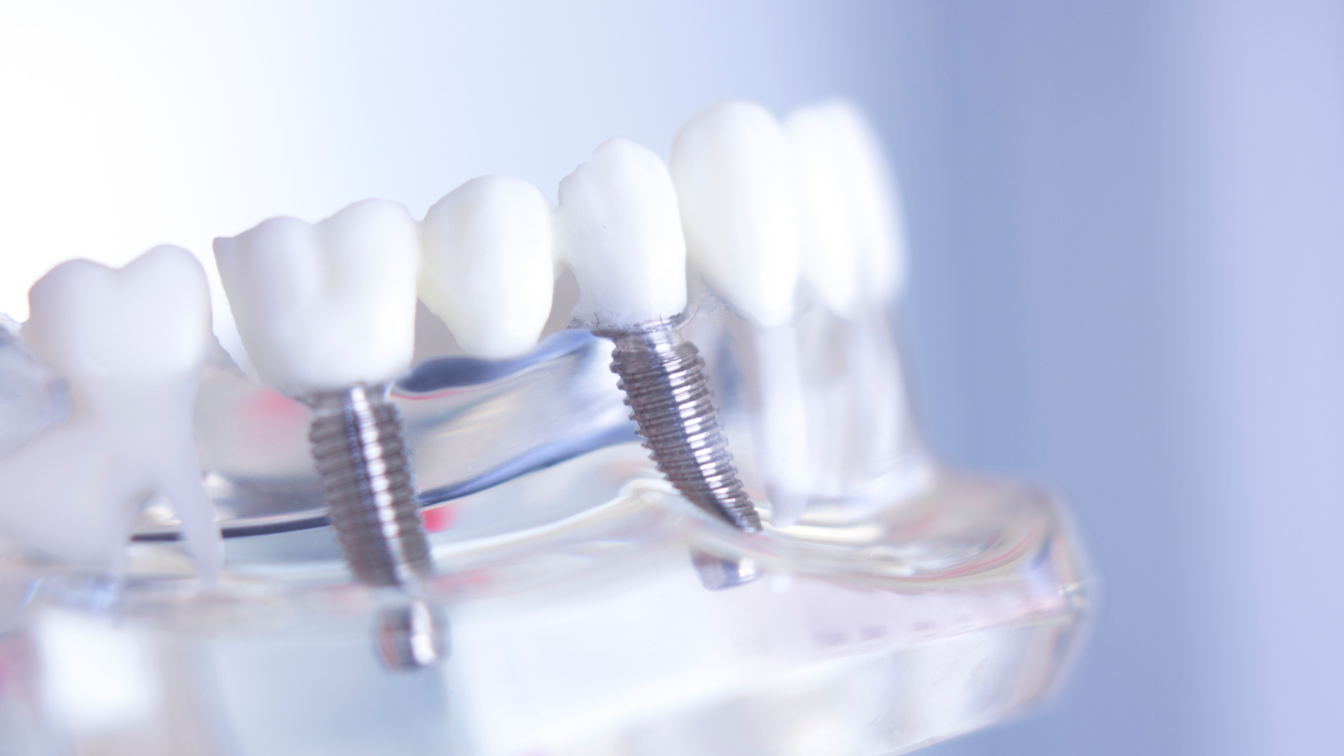 Close-up of dental implants and white artificial teeth in a clear model under soft blue light