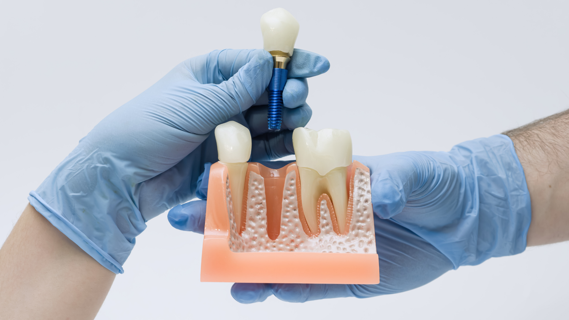 Gloved hands holding a dental implant model and drill against a white background