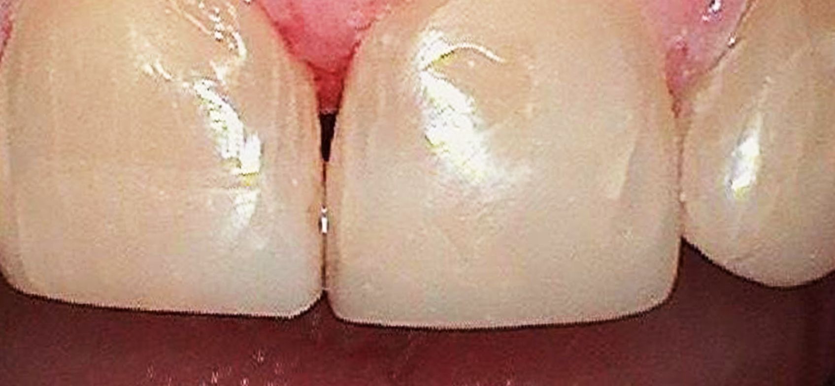 A close up of a person 's teeth with a red background.