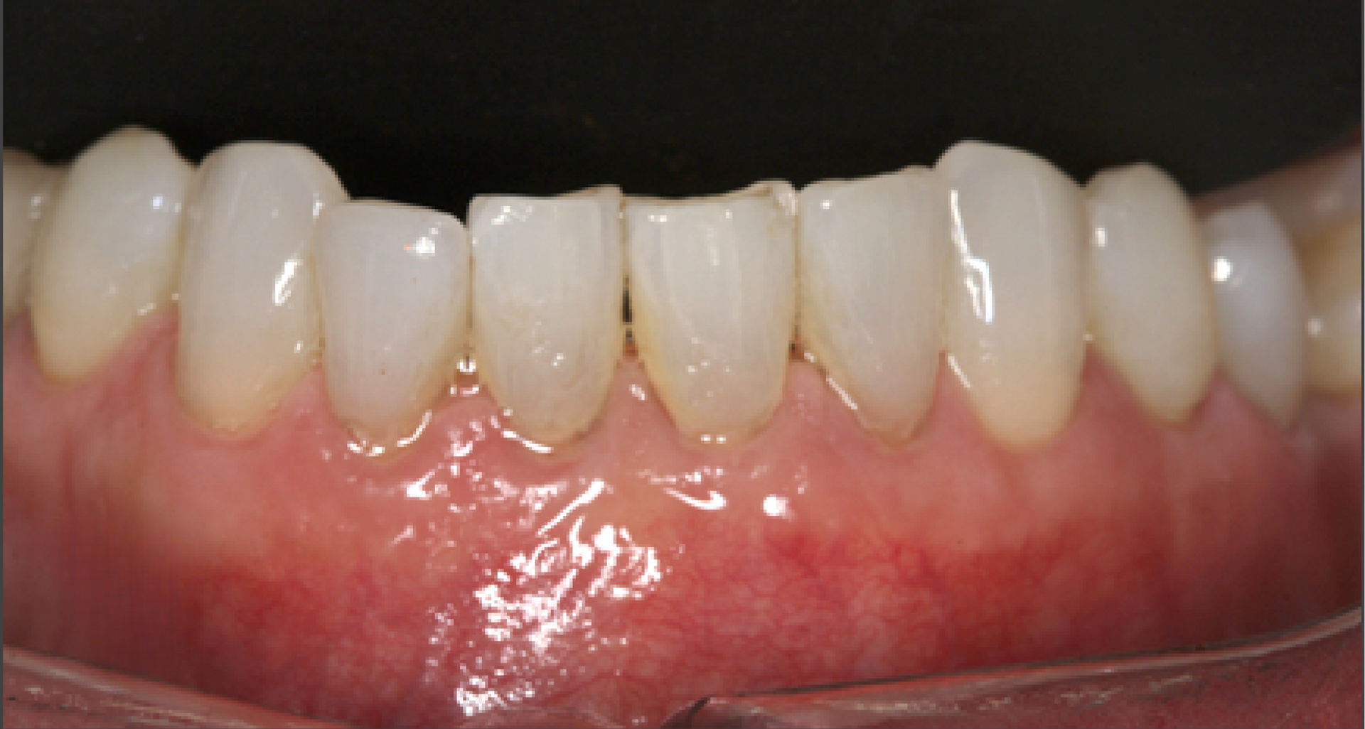 A close up of a person 's teeth with a shield in the corner