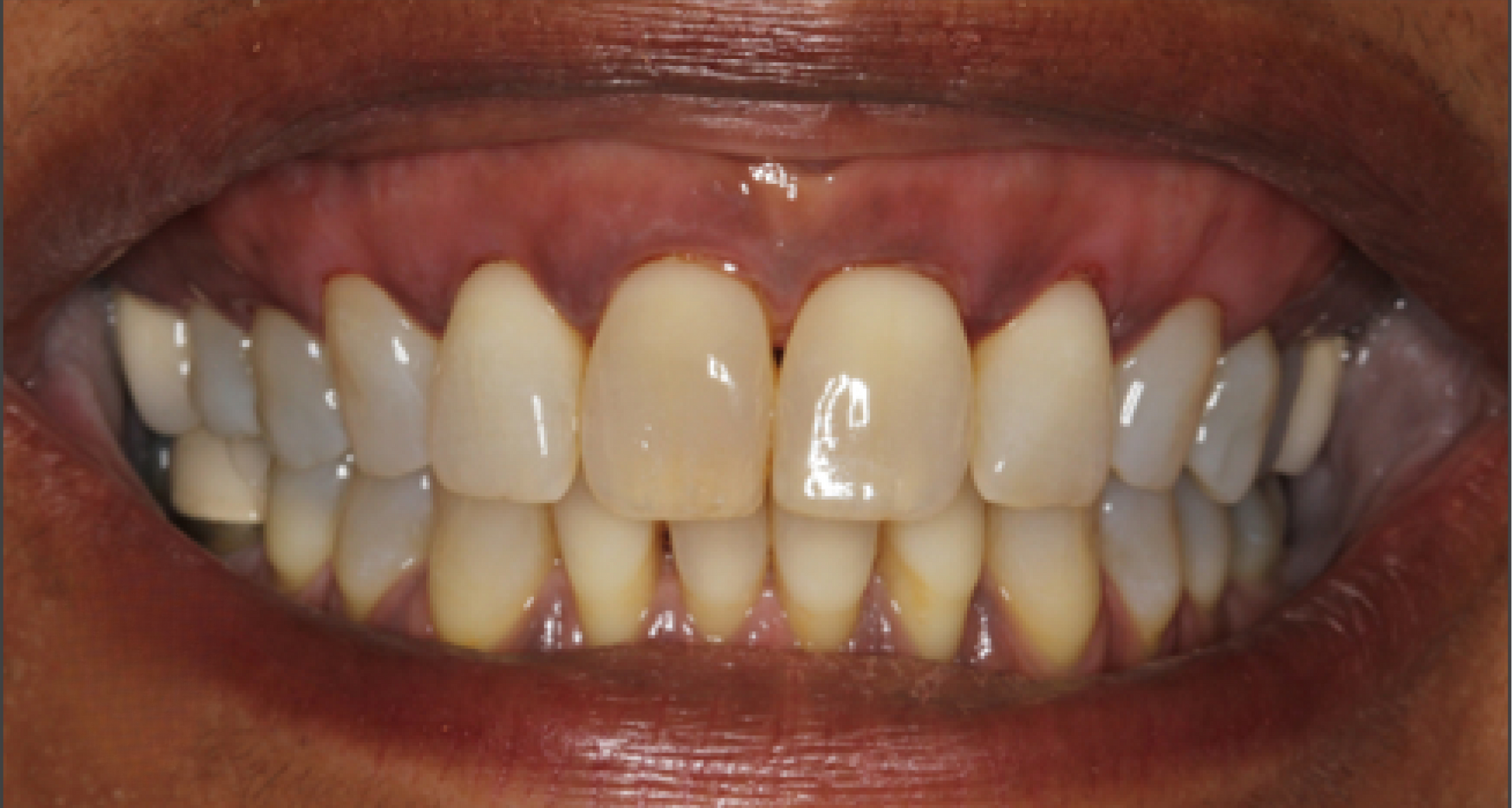 A close up of a person 's teeth with a shield in the corner