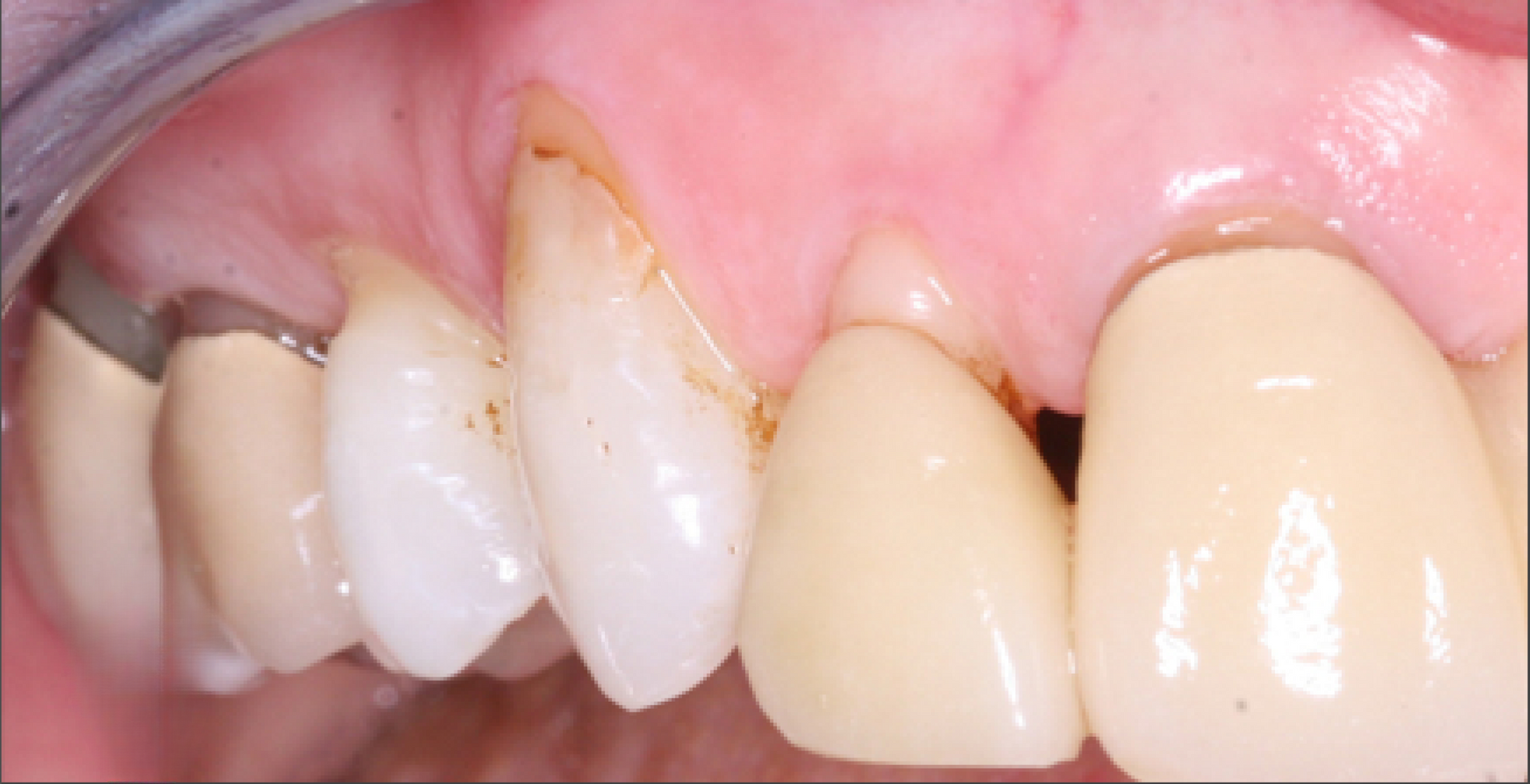 A close up of a person 's teeth with a broken tooth.