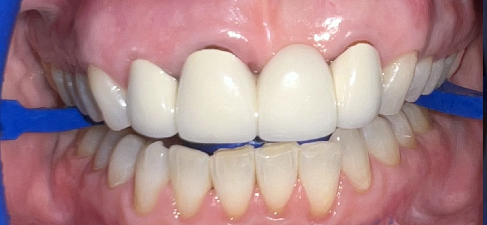 A close up of a person 's teeth with a blue rubber band around them.