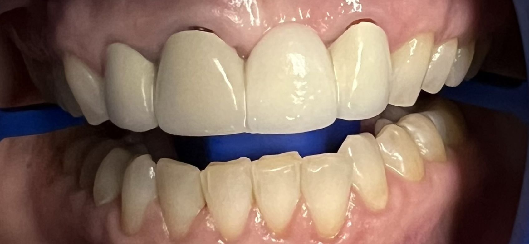 A close up of a person 's teeth with a blue rubber band around them.