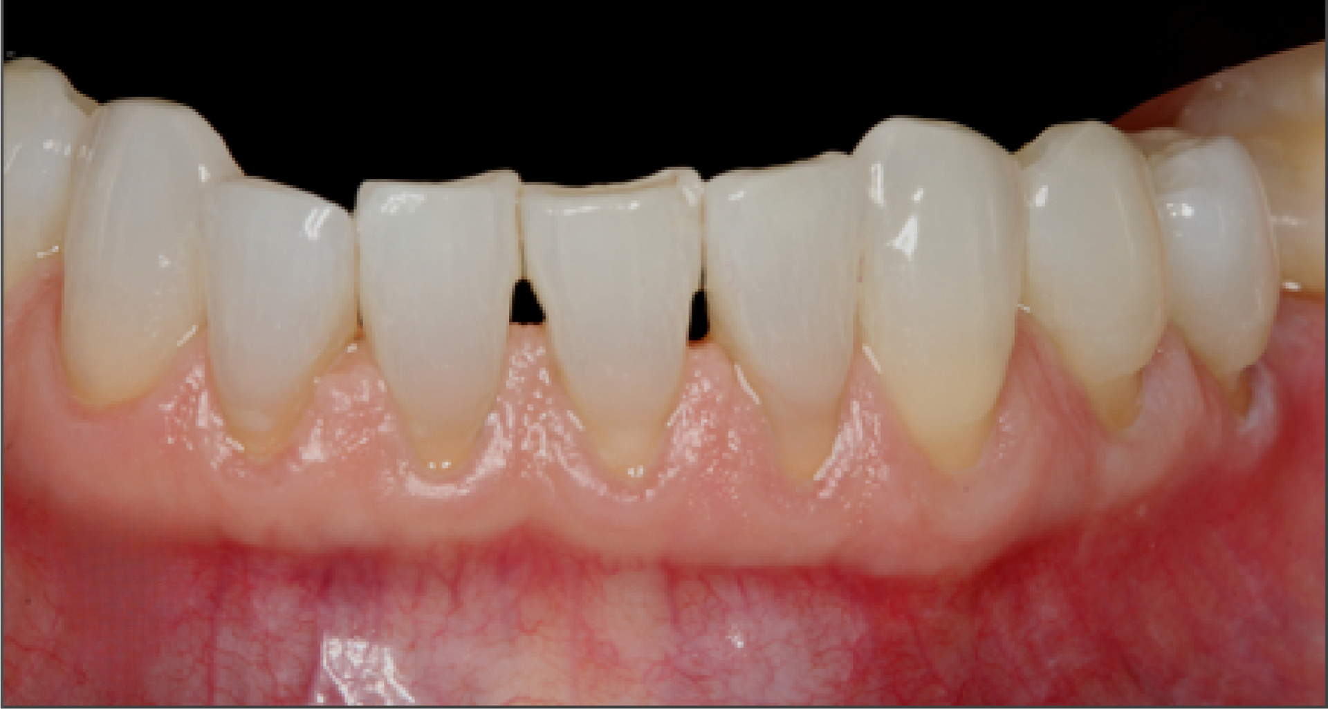 A close up of a person 's teeth with a black background.