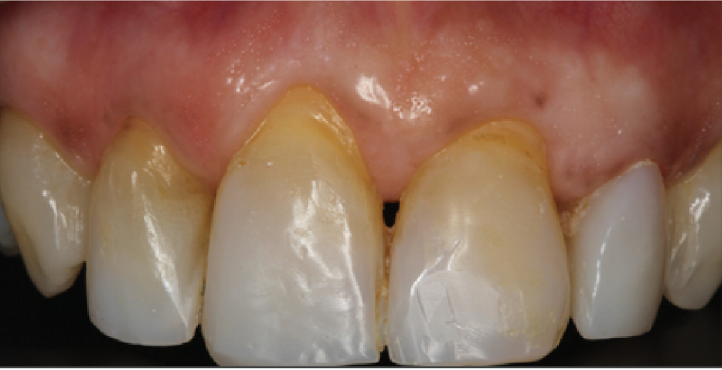 A close up of a person 's teeth and gums.