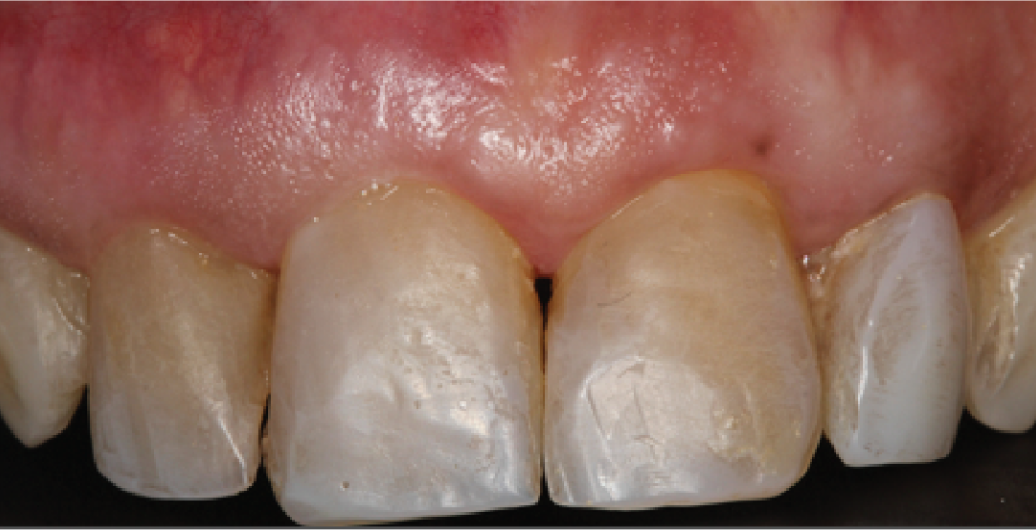 A close up of a person 's teeth with a shield on it.