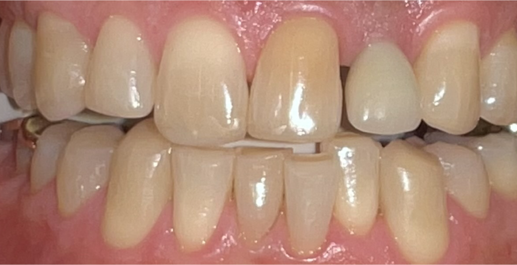 A close up of a person 's teeth with a metal brace.