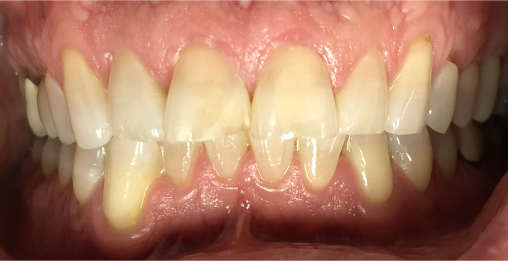 A close up of a person 's teeth with white teeth.