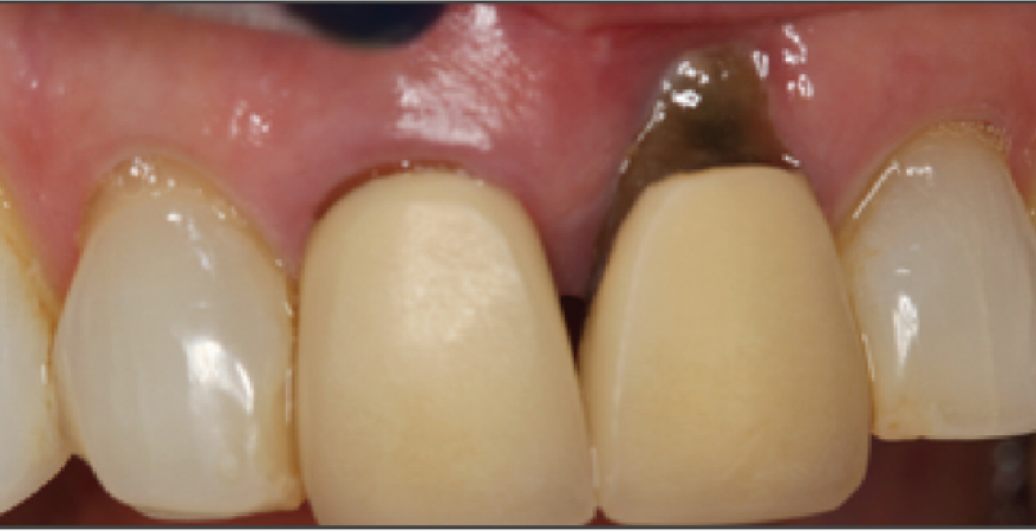 A close up of a person 's teeth with a tooth missing.