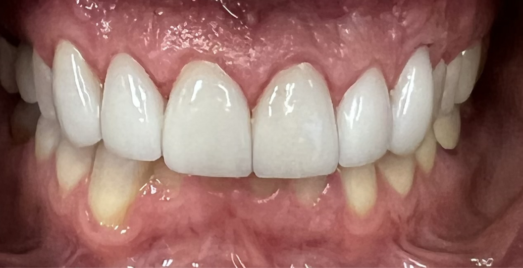 A close up of a person 's teeth with white teeth.