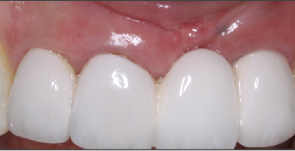 A close up of a person 's teeth with white teeth.