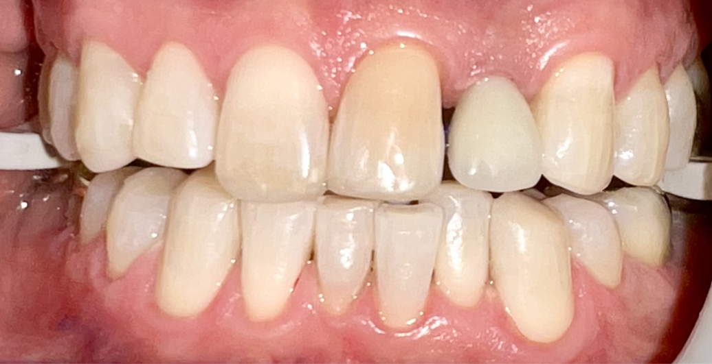 A close up of a person 's teeth with white teeth.