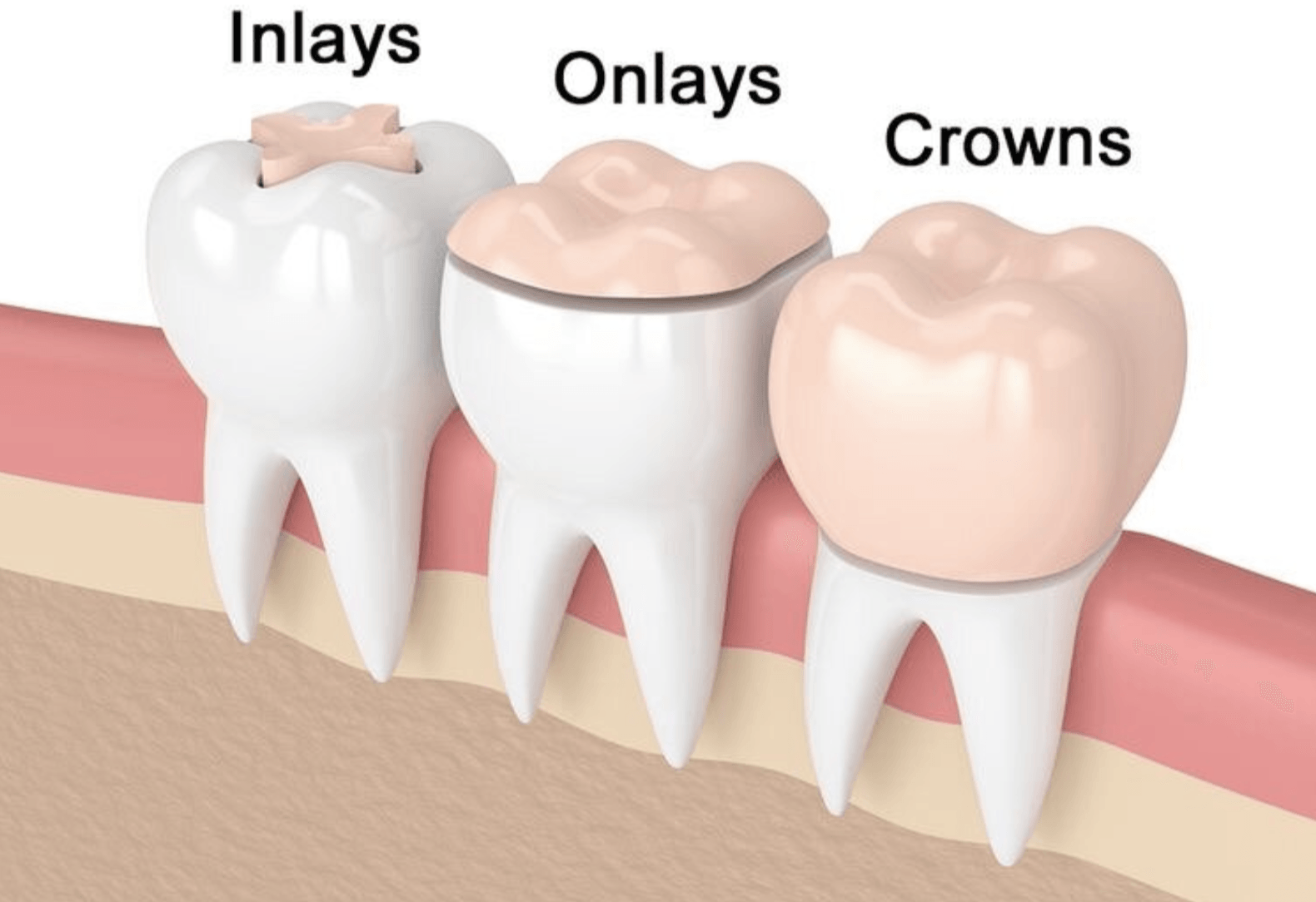 Inlays, Onlays, Crowns