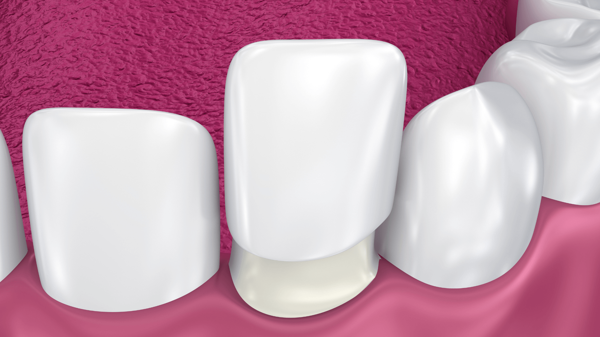 Porcelain Veneers