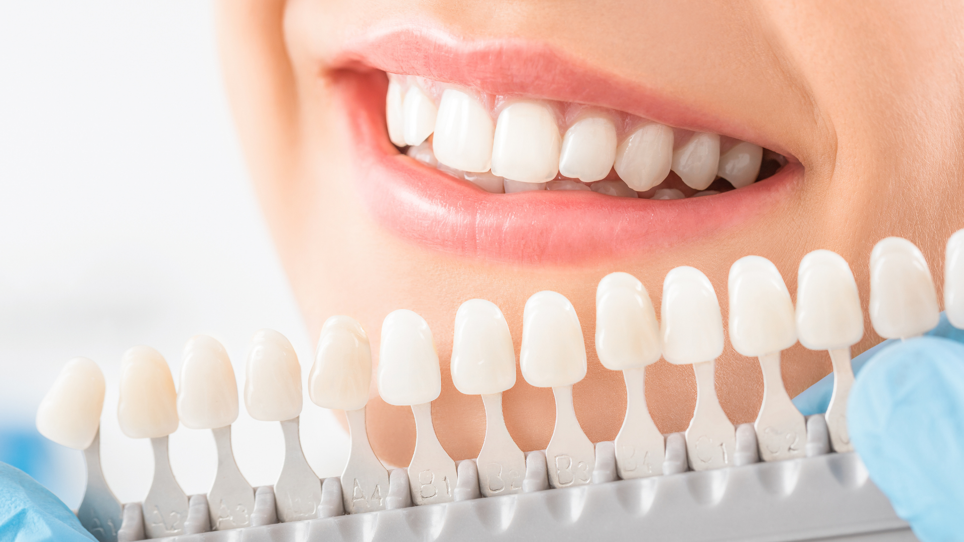 Dental shade guide held near smiling mouth, comparing teeth color to veneer samples